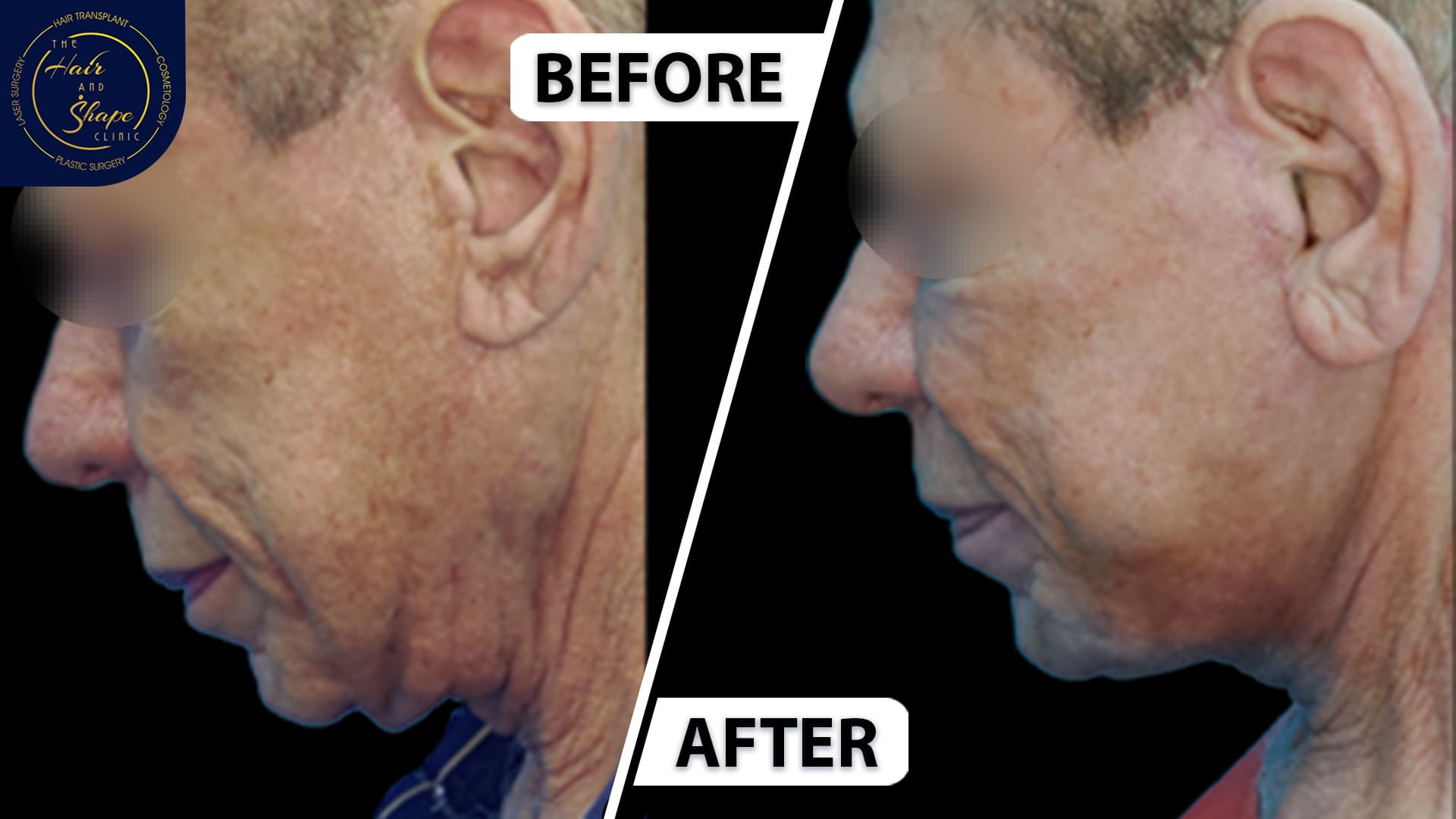 Face & Neck Lift result7
